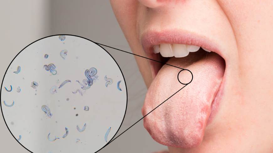 Nästan varannan person drabbas någon gång av svamp i munnen.  Foto: Shutterstock